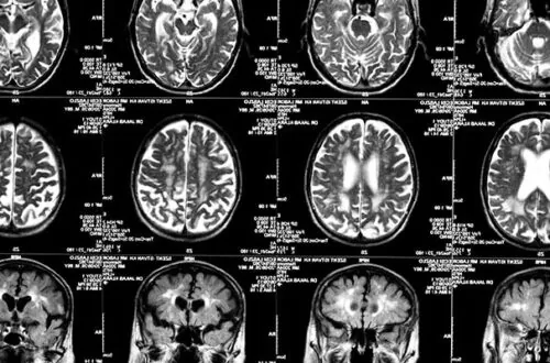 Brain Scans